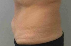 Coolsculpting Case 9 Before