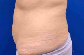 Coolsculpting Case 9 After