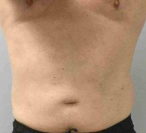 Coolsculpting Case 10 Before