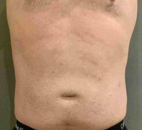 Coolsculpting Case 10 After