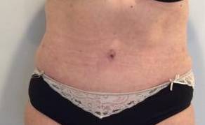 Tummy Tuck Case 1 After