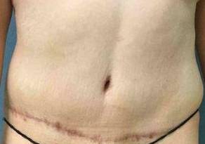 Tummy Tuck Case 2 After