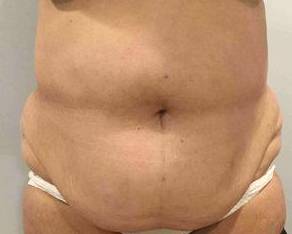 Tummy Tuck Case 3 Before