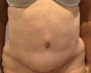 Tummy Tuck Case 3 After