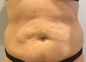 Tummy Tuck Case 4 Before