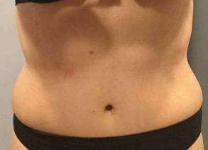 Tummy Tuck Case 4 After