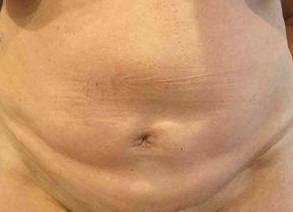 Tummy Tuck Case 5 Before