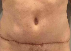 Tummy Tuck Case 5 After