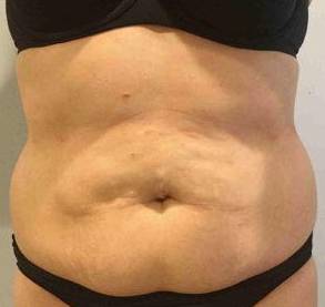 Tummy Tuck Case 6 Before