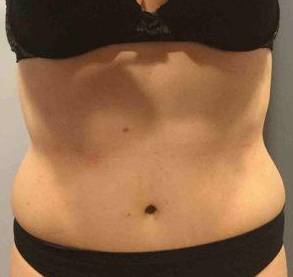 Tummy Tuck Case 6 After