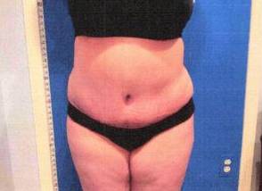 Tummy Tuck Case 7 After