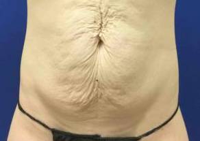 Tummy Tuck Case 8 Before