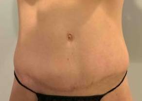 Tummy Tuck Case 8 After