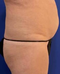 Tummy Tuck Case 9 Before