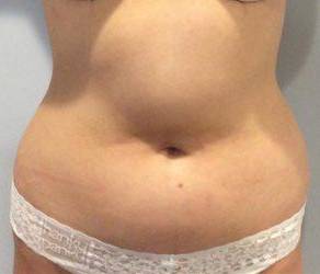 Liposuction Case 1 Before