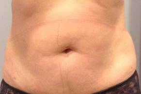 Liposuction Case 2 Before