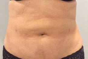 Liposuction Case 2 After