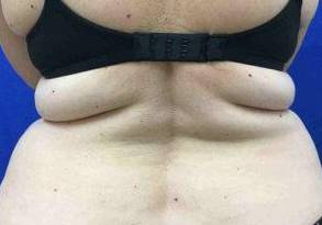 Liposuction Case 3 Before