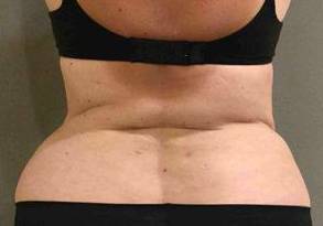 Liposuction Case 3 After