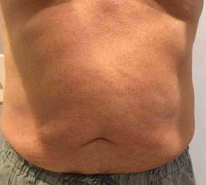 Liposuction Case 4 Before