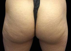 EMSCULPT Female Buttock Case 1 Before