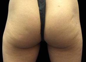 EMSCULPT Female Buttock Case 1 After