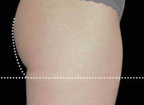 EMSCULPT Female Buttock Case 2 After