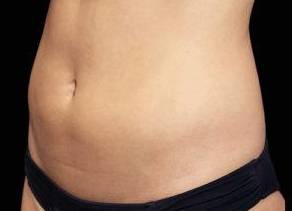 EMSCULPT Female Abdomen Case 3 Before