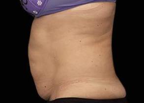 EMSCULPT Female Abdomen Case 4 Before