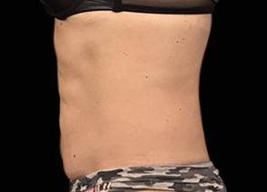 EMSCULPT Female Abdomen Case 4 After