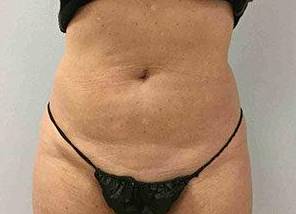 EMSCULPT Female Abdomen Case 5 Before