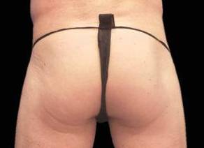 EMSCULPT Male Buttock Case 1 After