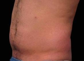 EMSCULPT Male Abdomen Case 1 Before