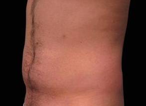 EMSCULPT Male Abdomen Case 1 After