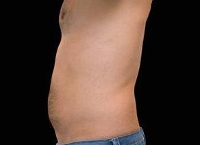 EMSCULPT Male Abdomen Case 2 Before