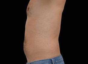 EMSCULPT Male Abdomen Case 2 After