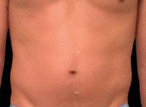 EMSCULPT Male Abdomen Case 3 Before