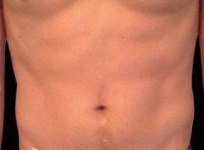 EMSCULPT Male Abdomen Case 3 After