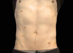 EMSCULPT Male Abdomen Case 4 Before