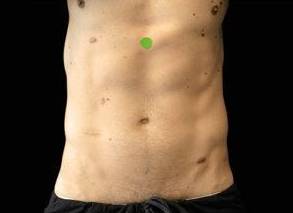 EMSCULPT Male Abdomen Case 4 After