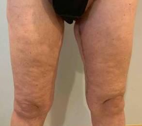 Thigh Lift After