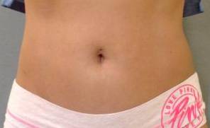 Coolsculpting Case 1 After