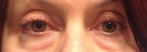 Blepharoplasty Case 2 Before