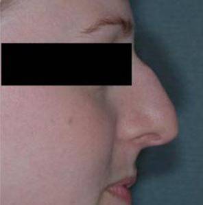 Rhinoplasty Case 1 Before