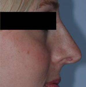 Rhinoplasty Case 1 After