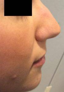 Rhinoplasty Case 2 Before