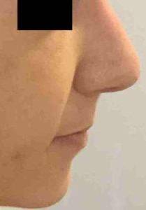 Rhinoplasty Case 2 After