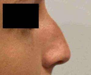 Rhinoplasty Case 3 Before