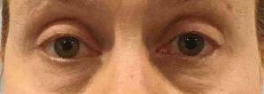 Blepharoplasty Case 2 After