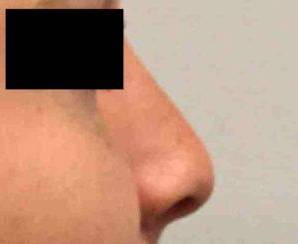 Rhinoplasty Case 3 After